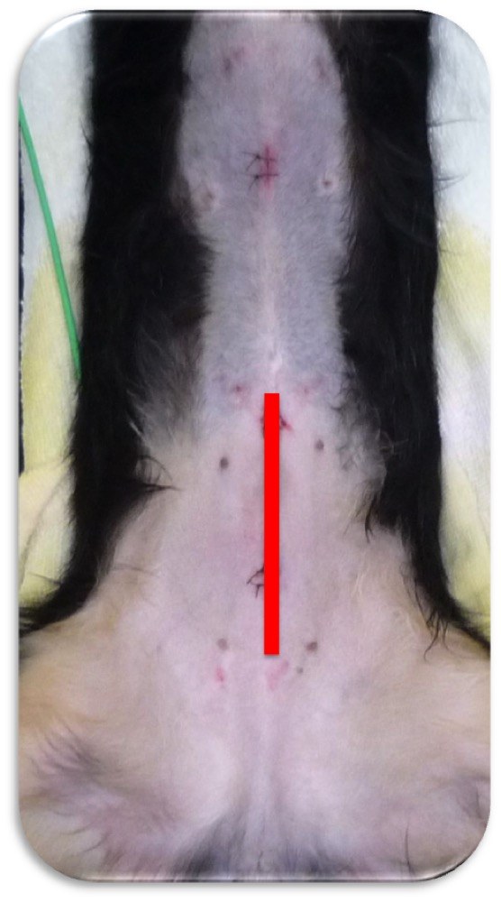 開腹手術の切開範囲を赤い線で重ねた比較。腹腔鏡の傷がいかに小さいかがわかる